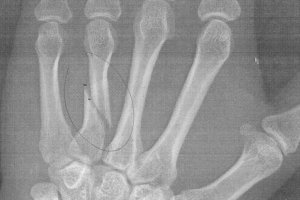 [xray: Wei-Hwa's Hand]